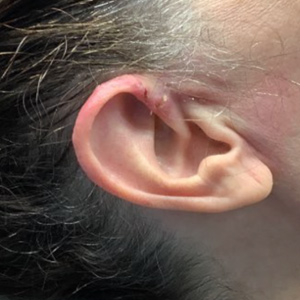 Ear Img13