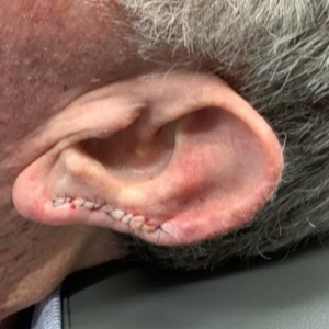 Ear Img15