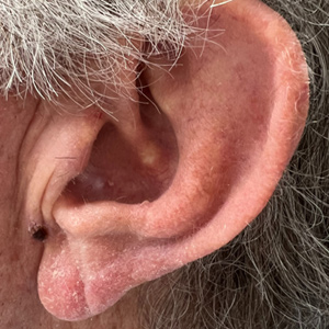 Ear Img17