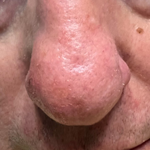 nose Img8